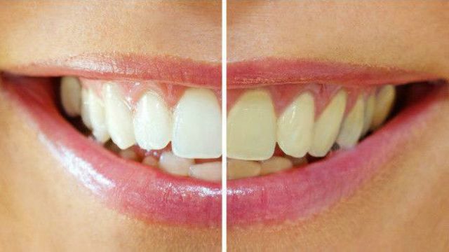 10 способов отбелить зубы в домашних условиях