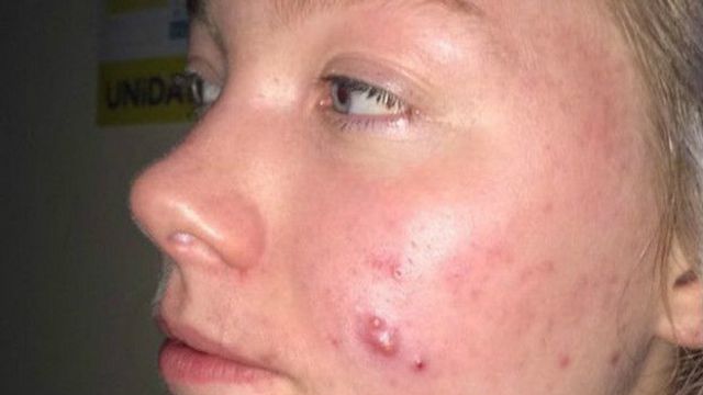 Cinco Coisas Que Nao Se Deve Dizer Para Quem Tem Acne Bbc News Brasil