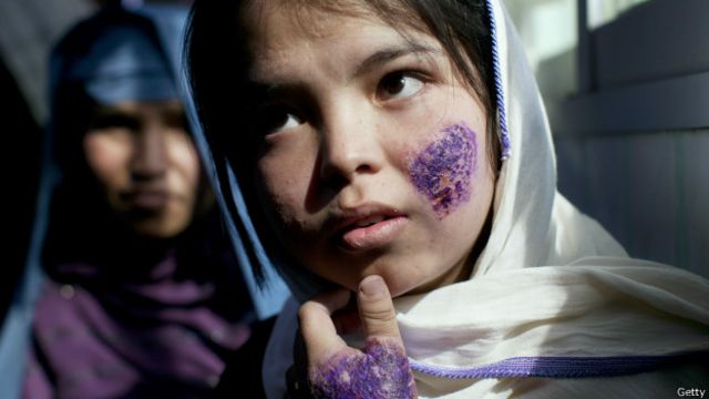 Niña con lesiones de leishmaniasis en el rostro