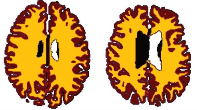 肥胖的中年人腦內白質明顯減少（左）