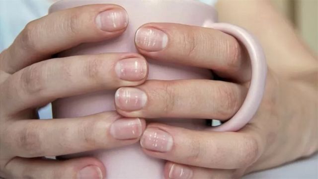有关多少人出现新冠指甲方面的数据很有限，但据估计它可能影响1-2%的新冠患者。(photo:BBC)