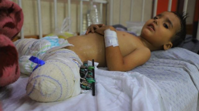 Ahmed Shabat, de 3 años de edad, en el hospital