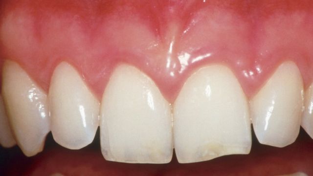 口腔健康与全身健康：深层牙龈疾病的潜在危险(photo:BBC)