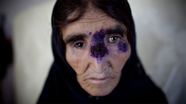Mulher com leishmaniose recebe tratamento em Cabul, no Afeganistão, em 2010