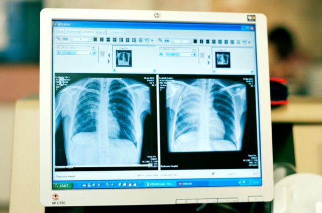 Carly Clarke's scan results showing tumour, as seen on a consultant's PC monitor