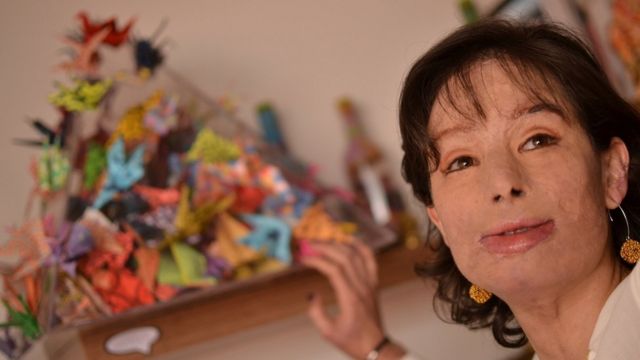 Natalia Ponce de León fue víctima de un ataque con ácido en 2014, en Colombia.