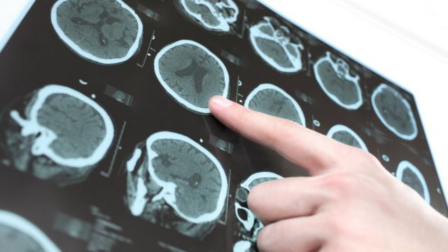 First hints Parkinson's can be stopped