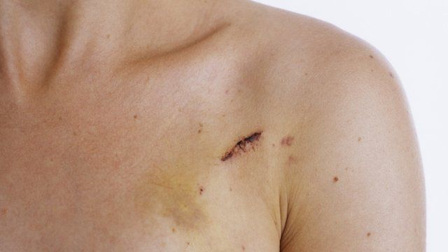 Pacemaker scar