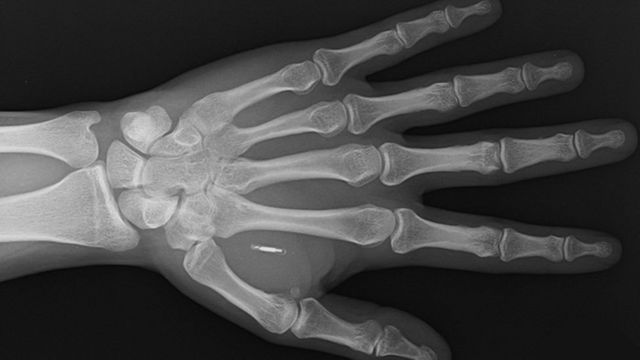 X-ray showing the slide implanted in the left hand of a person