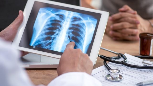 Un médico revisando una radiografía de unos pulmones