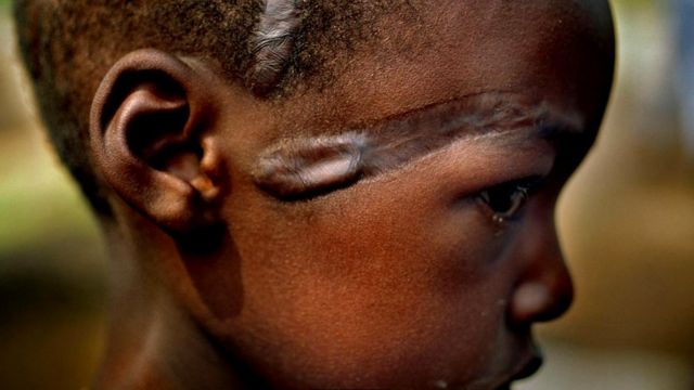 Огнестрельное оружие - вовсе не обязательное условие насилия, как свидетельствует эта фотография ребенка из племени хуту, на лице которого шрам от мачете, полученный в 1994 году, во время руандийского геноцида
