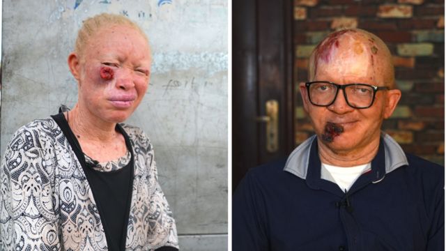 klæde sig ud komme Tablet Albinism: How albinos dey fight skin cancer - BBC News Pidgin
