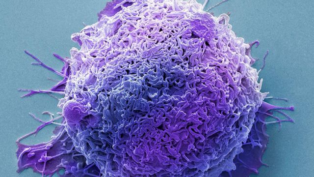 Muitas das bactérias associadas ao câncer colorretal podem trabalhar juntas para piorar a condição do paciente