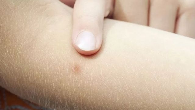 கொசு கடித்து சிவந்த தோல் பகுதி.