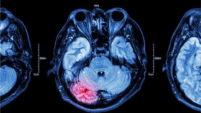 Radiografía de un cerebro