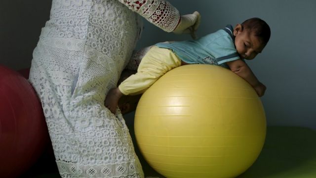 Bebê com microcefalia faz fisioterapia em Campina Grande (PB)