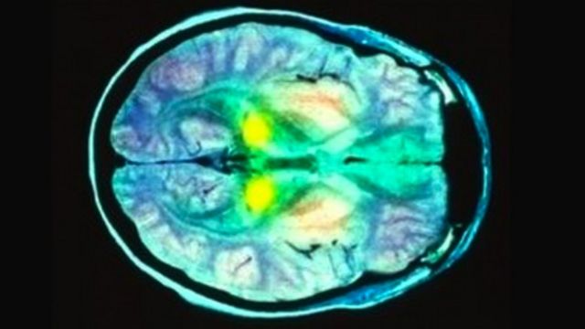 مسح للدماغ يظهر جزء من الدماغ مظلل باللون الأصفر