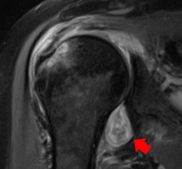 Imagem de ressonância magnética do ombro de um paciente. A seta vermelha indica uma inflamação na articulação