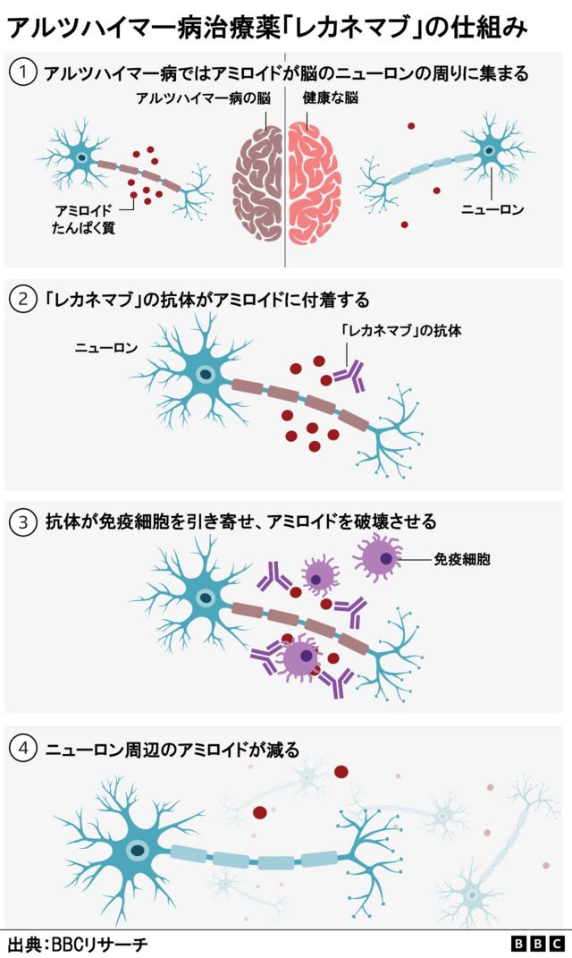 アルツハイマー病の原因