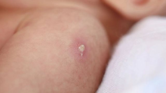 Lesão em braço de bebê após tomar vacina BCG