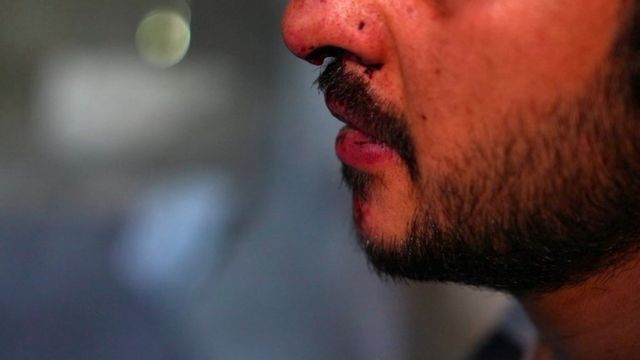 Foto de un hombre con la nariz ensangrentada y la barba solo visible de la nariz hacia abajo.