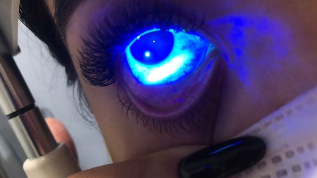 Fotografía de primer plano del ojo de Adne, bajo luz azul, en un examen.