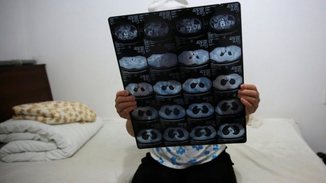 Mujer levanta sus placas radiográficas en las que se refleja su tumor. Ella está sentada en su cama.