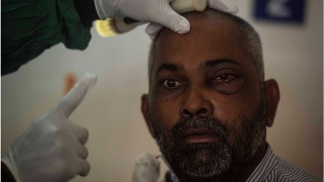 Covid di India diperparah penyakit 'jamur putih' - infeksi kebal obat