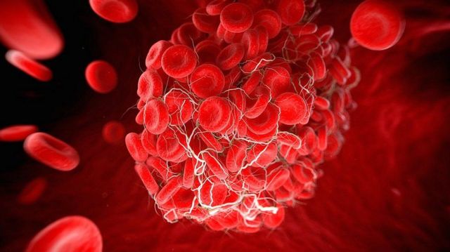 ภาพขยายเซลล์เม็ดเลือดแดงขณะเกิดลิ่มเลือด