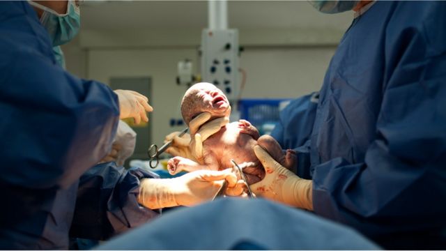 Bebé naciendo por cesárea.