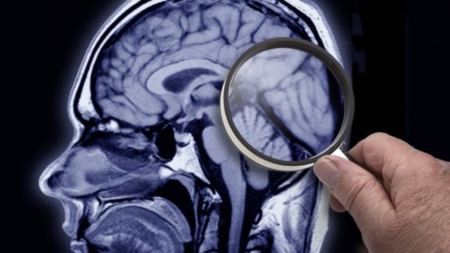Imagen de resonancia magnética de una cabeza con una lupa examinando el cerebro.