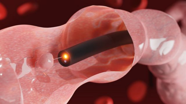 கலோனோஸ்கோபி