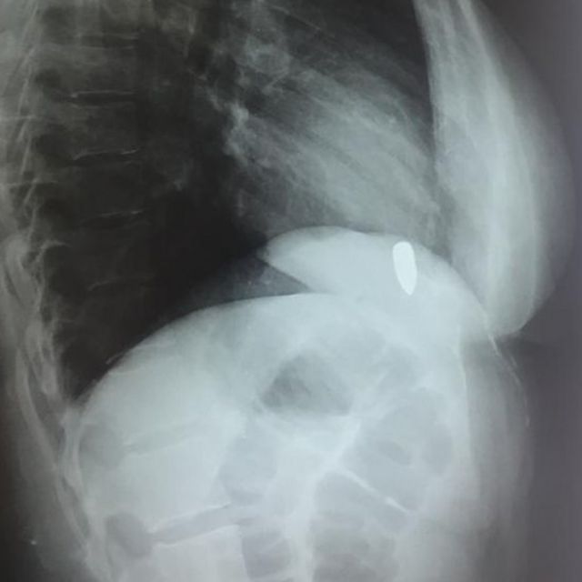 எக்ஸ் ரேவில் தெரியும் துப்பாக்கி தோட்டா