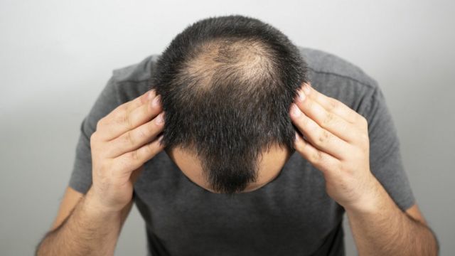 3 Myths About Baldness And Why It's Not 'Necessarily Bad', According To Experts 2 Top of a bald man's head, who looks down and places his hands on his head, looking worried