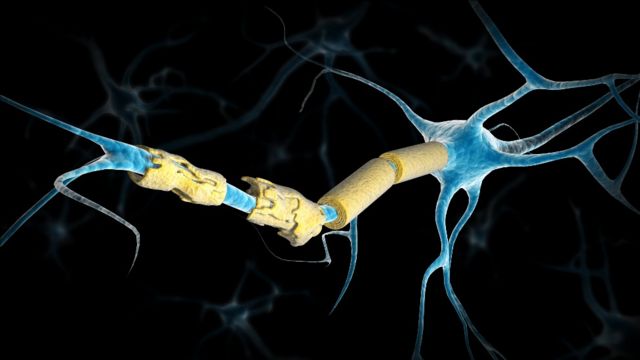 Illustrazione della mielina danneggiata in un neurone di una persona con sclerosi multipla