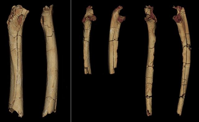 The femur and ulna were diagnosed in 2001