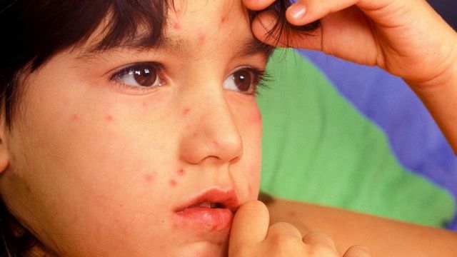 Criança com varíola