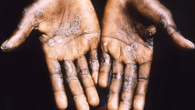 As palmas das mãos de um paciente com lesões de pele devido à varíola dos macacos