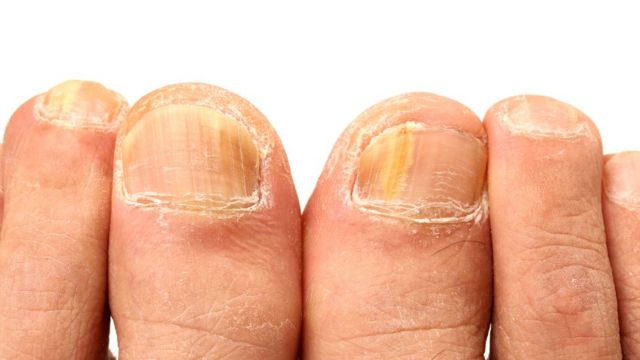 Frágiles, amarillentas o con blancas: cuáles son las anomalías y problemas frecuentes de las uñas - BBC News Mundo