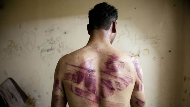 Exprisionero de una cárcel en Alepo en Siria con marcas rojas de quemaduras y heridas en la espalda