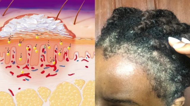 psoriasis or dandruff on scalp