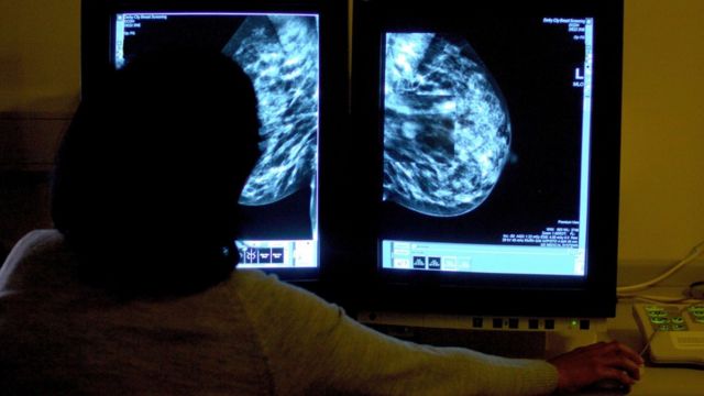 Un profesional estudia una mamografía