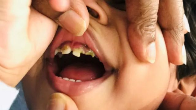 Tharunicaa's rotting teeth