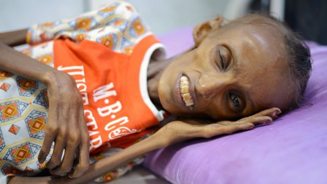 Saida Ahmad Baghili en la cama de un hospital en Yemen.