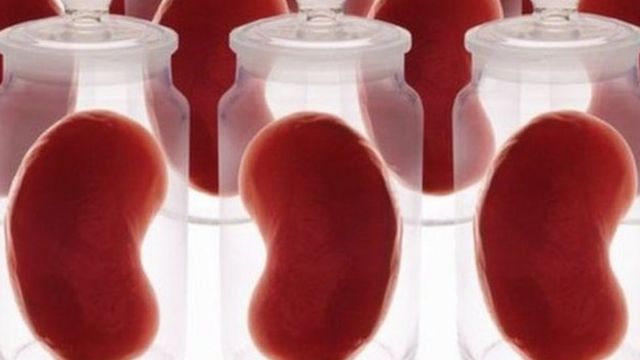 Azərbaycanda 200-ə yaxın insan böyrək transplantasiyası üçün növbə gözləyir