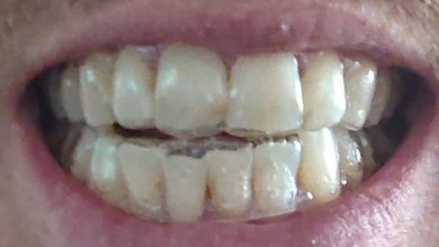 Jamie's teeth showing damage