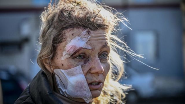 A wounded woman stands outside a hospital after the bombing of the eastern Ukraine town of Chuguiv on February 24, 2022