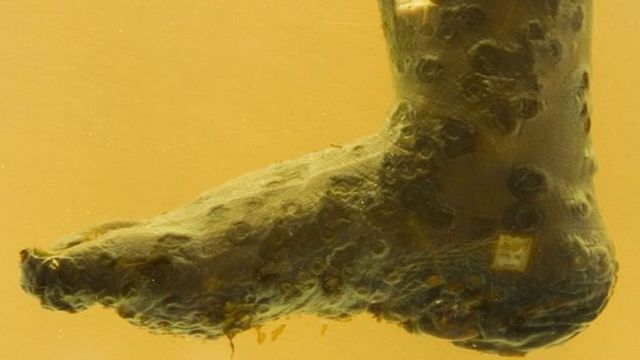Un pie preservado de una persona que murió a causa de la viruela.