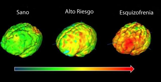 Las imágenes de tres cerebros radiados con diferentes colores según actividad cerebral.