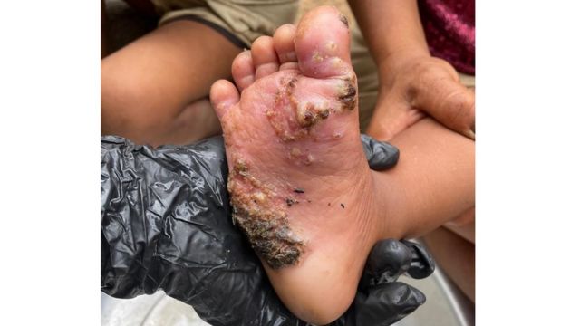 pé de criança Yanomami com feridas causadas por tungíase